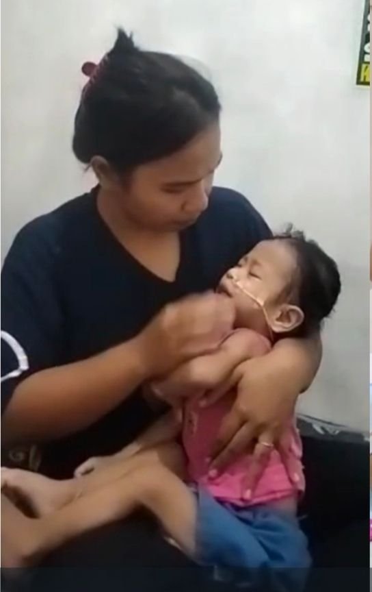 Arisa Bayi Mungil Penderita Jantung Bocor Yang Diabaikan Bupati Deliserdang Akhirnya Sampai Di RS Jantung Jakarta, Berharap Uluran Tangan Yang baik ha