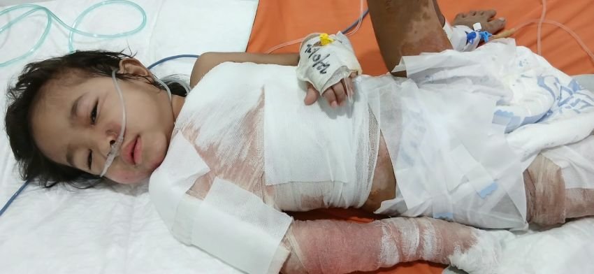 Pascaoperasi, Kondisi Kayla Bocah Korban Luka Bakar Dilaporkan Membaik
